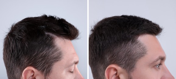 Man showing hair before and after dandruff treatment on grey background, collage