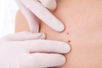 Photo of Dermatologist examining patient in clinic, closeup view