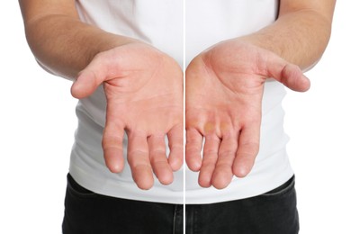 Image of Man showing hands without and with calluses on white background., closeup. Collage 