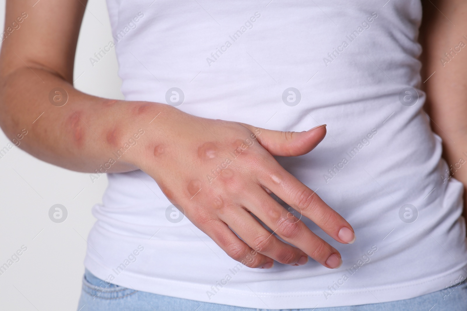 Photo of Woman with rash suffering from monkeypox virus on white background, closeup