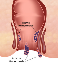 Hemorrhoid. Unhealthy lower rectum with inflamed vascular structures, illustration