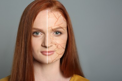 Image of Dry skin treatment. Beautiful young woman before and after procedure on grey background, collage. Space for text