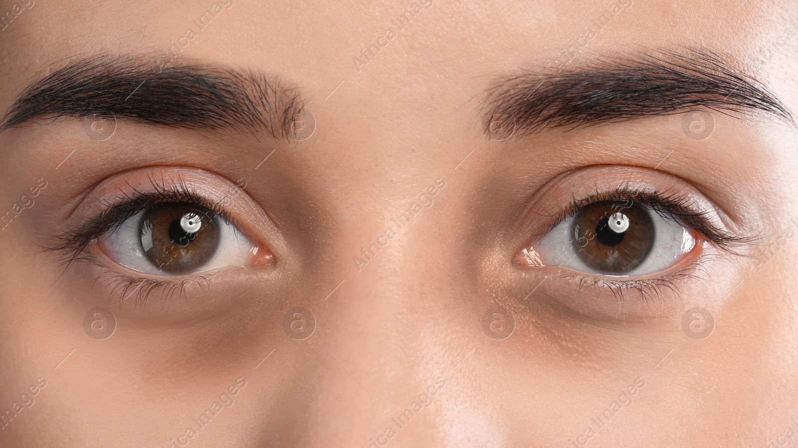 Image of Tired young woman with dark circles under eyes, closeup
