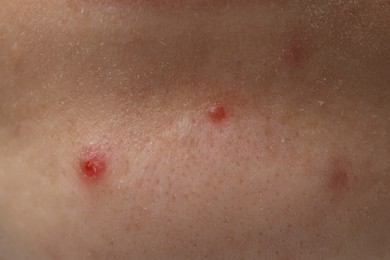 Photo of Young woman with acne on her face, closeup