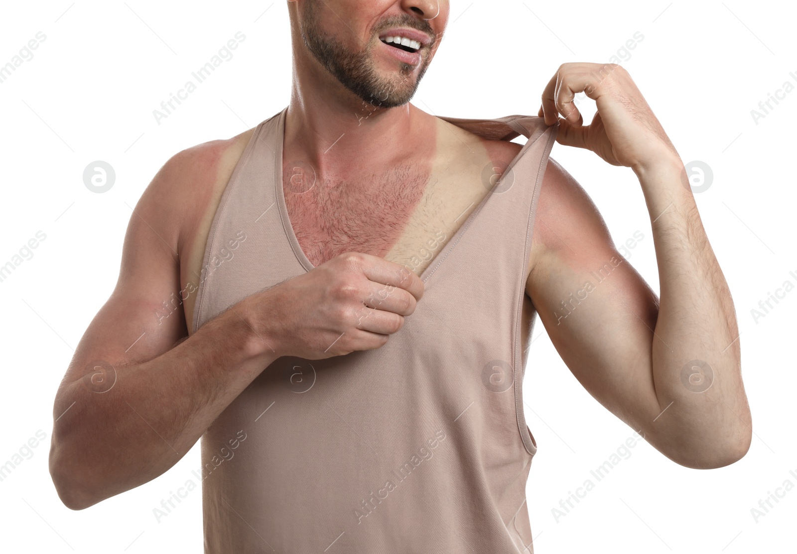 Photo of Man with sunburned skin on white background, closeup