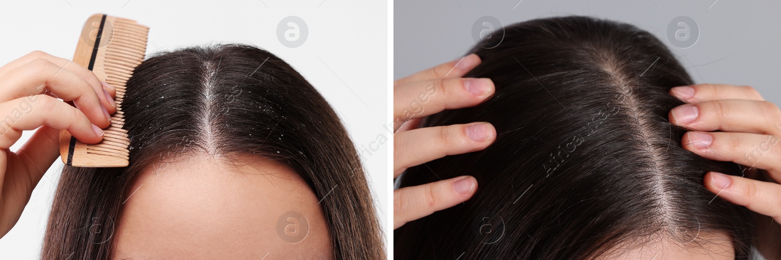 Image of Woman showing hair before and after dandruff treatment on color backgrounds, collage