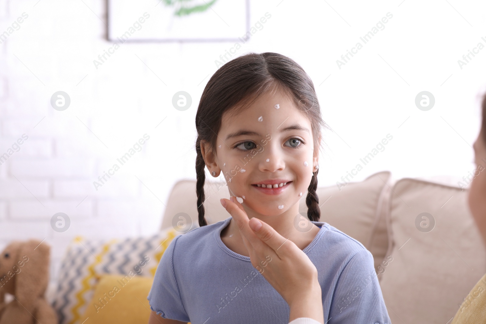 Photo of Mother applying cream onto skin of her daughter with chickenpox at home