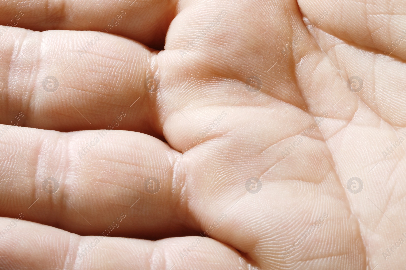 Photo of Closeup view of human hand with dry skin