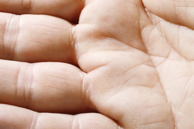 Closeup view of human hand with dry skin