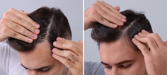 Man showing hair before and after dandruff treatment on grey background, collage