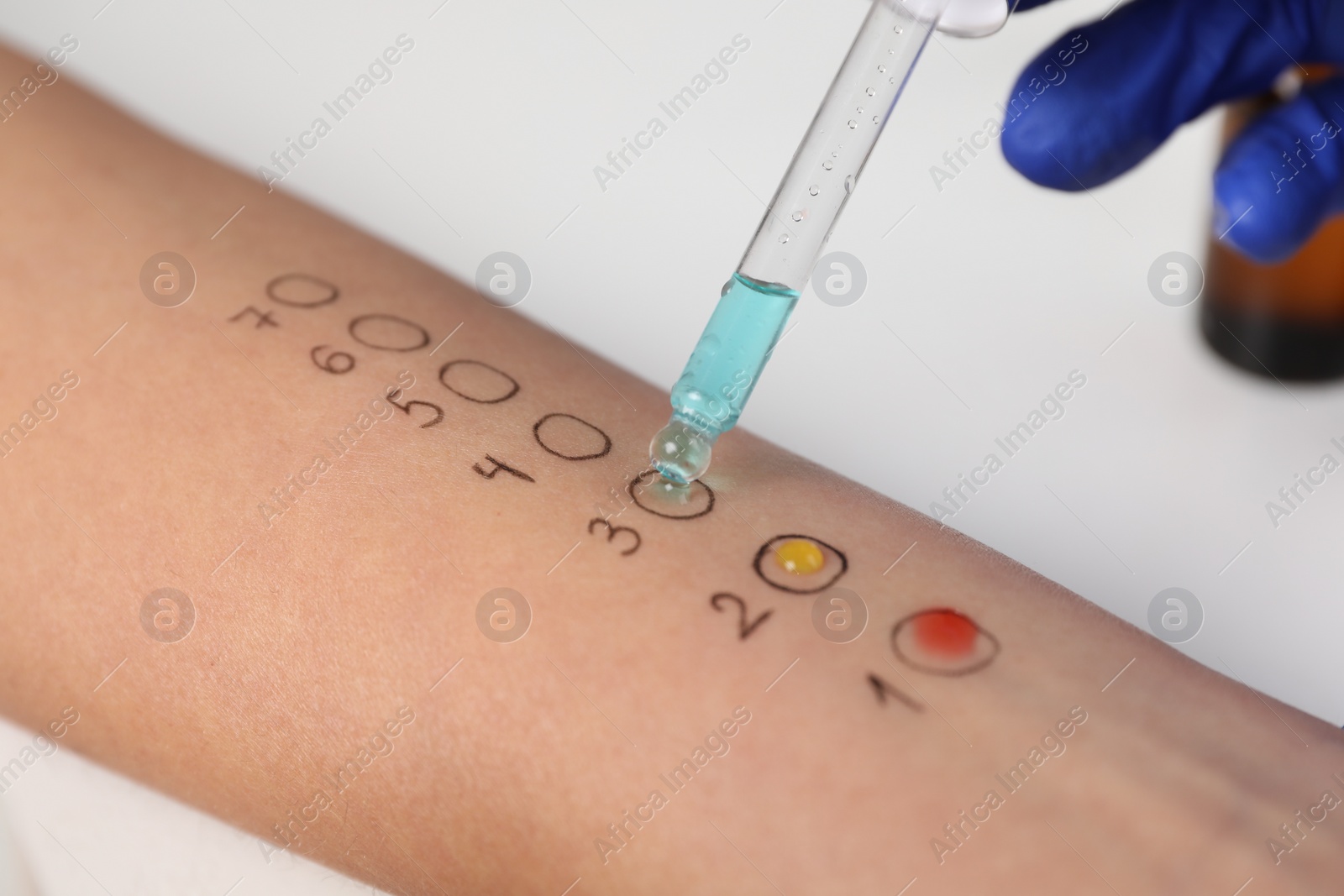 Photo of Patient undergoing skin allergy test at light table in clinic, closeup