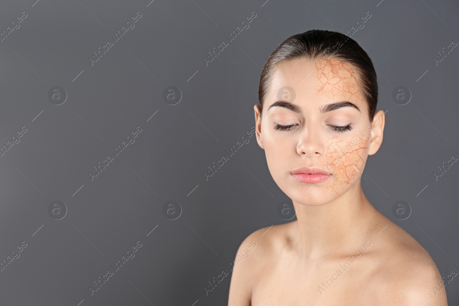 Image of Beautiful young woman with dry skin on grey background. Space for text