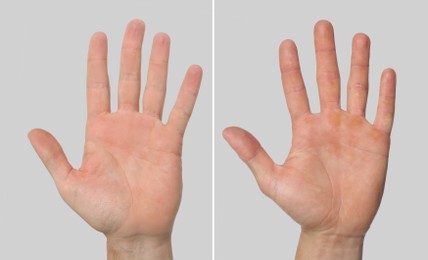 Man showing hands without and with calluses on light grey background., closeup. Collage 