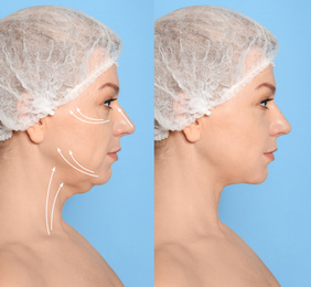 Mature woman before and after plastic surgery operation on blue background. Double chin problem 