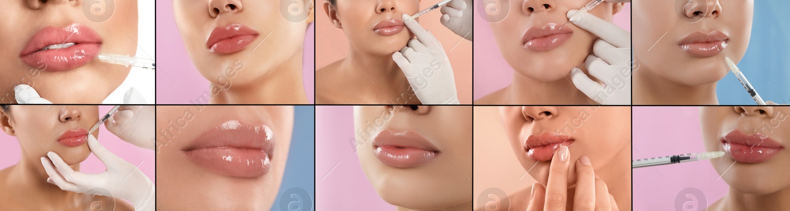 Image of Collage with photos of woman during lip augmentation procedure. Banner design