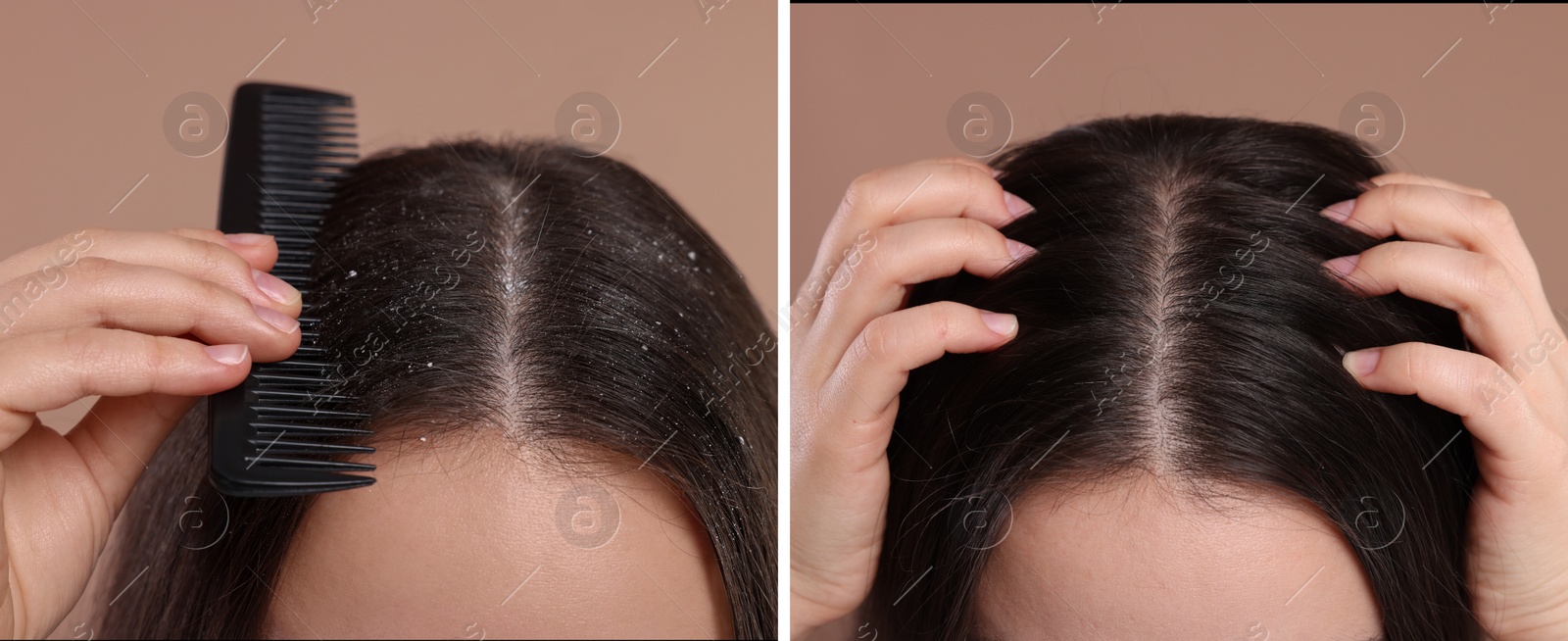 Image of Woman showing hair before and after dandruff treatment on brown background, collage