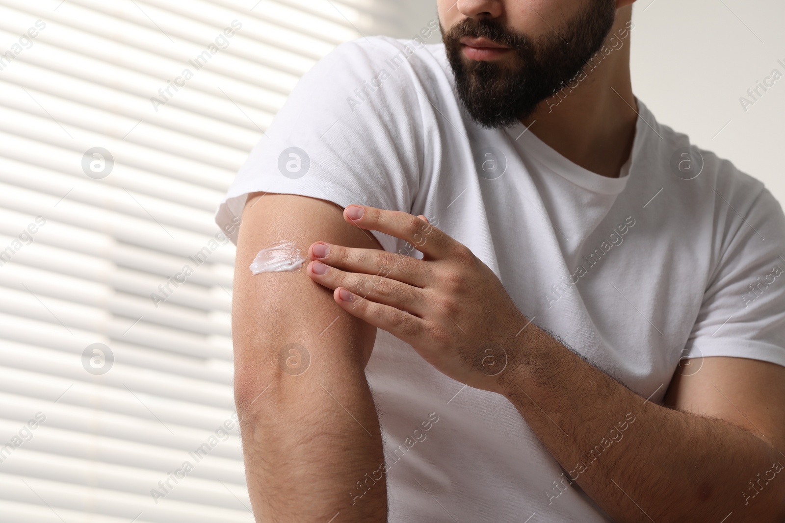 Photo of Man with dry skin applying cream onto his arm indoors, closeup