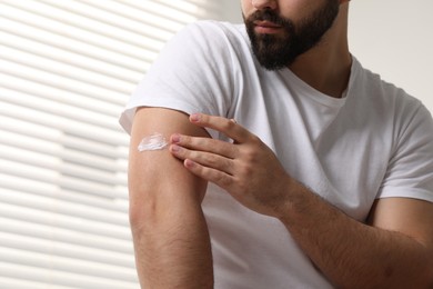 Man with dry skin applying cream onto his arm indoors, closeup