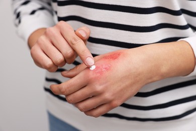 Photo of Woman applying healing cream onto burned hand on light grey background, closeup