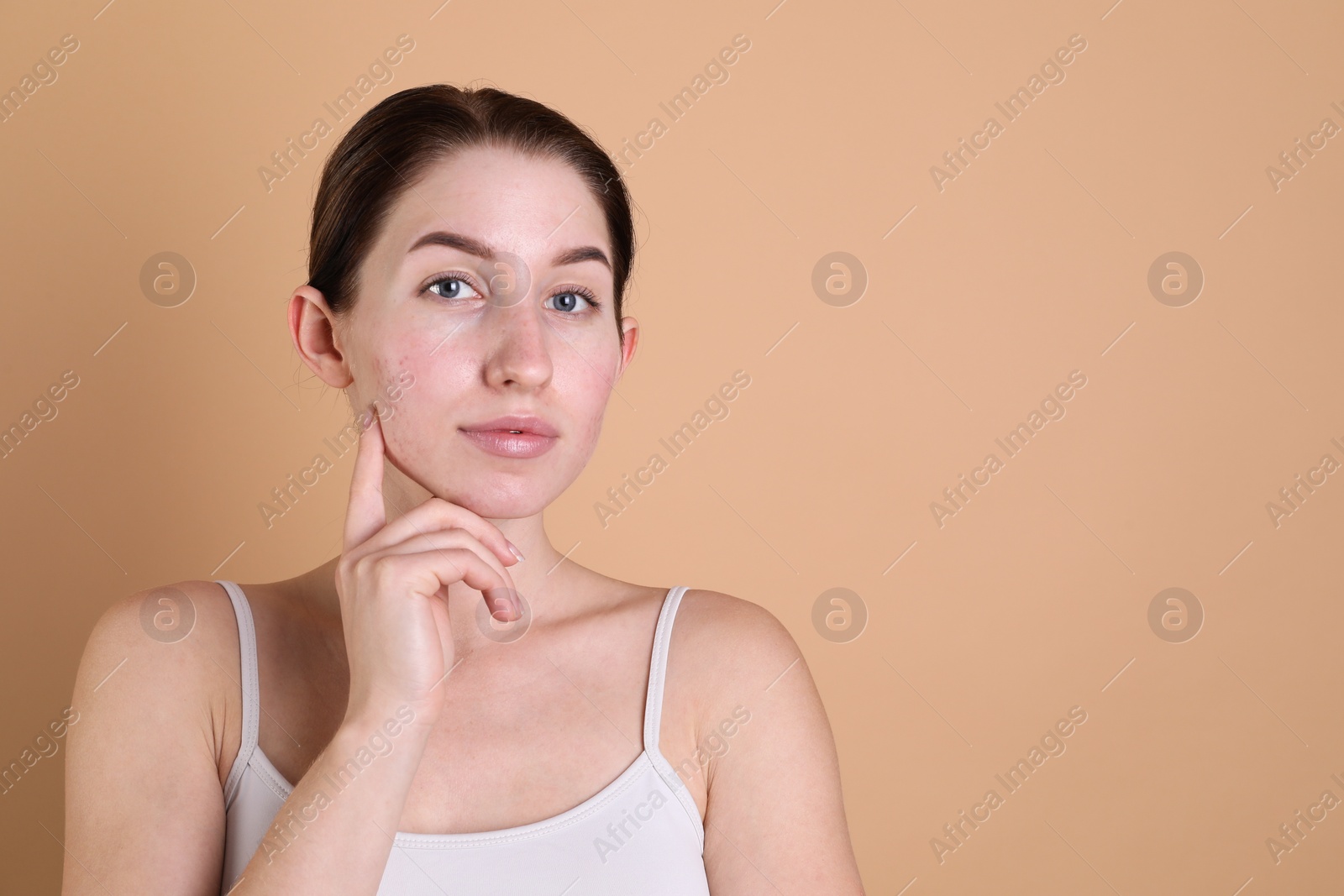 Photo of Young woman with acne problem on beige background. Space for text