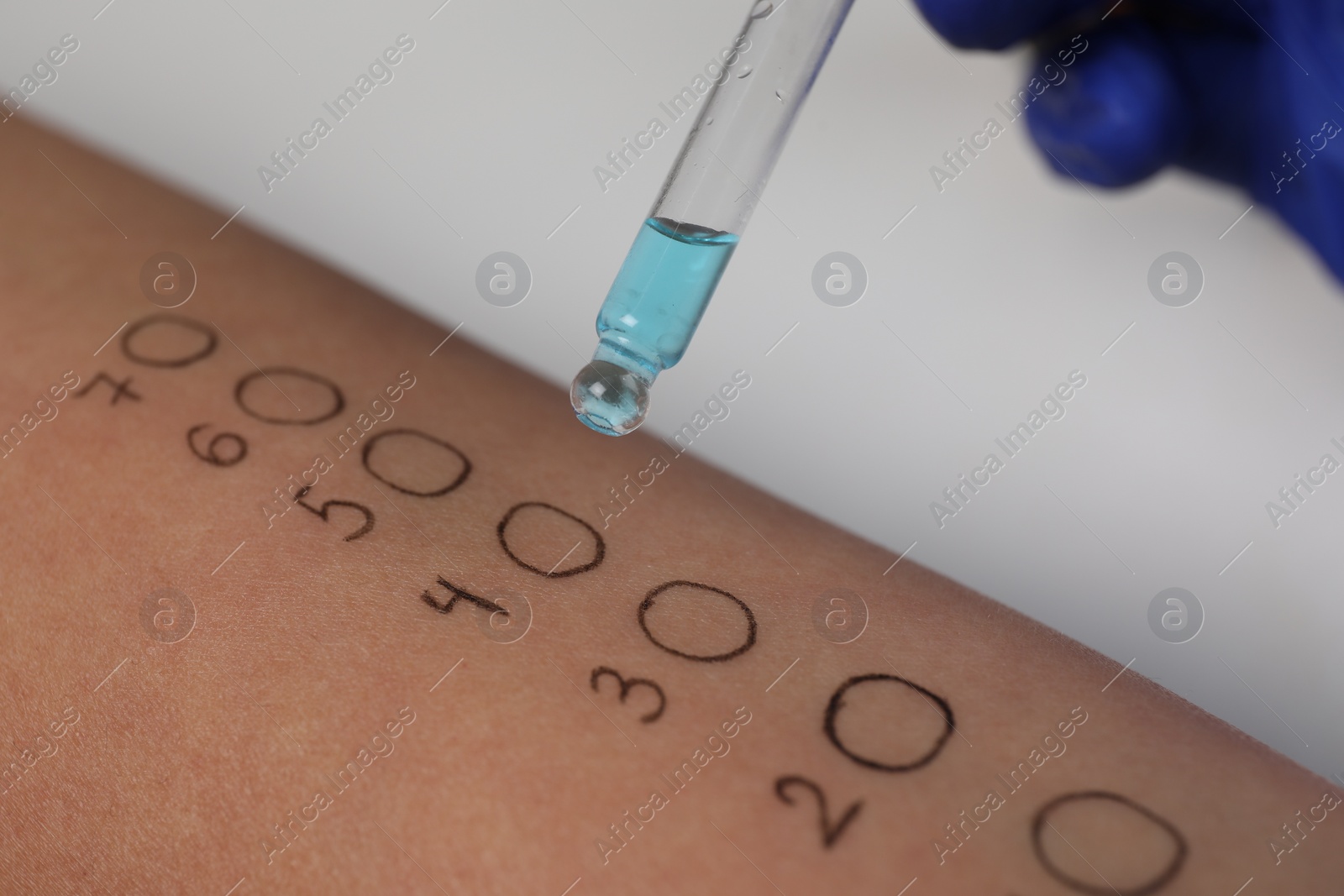 Photo of Patient undergoing skin allergy test at light table in clinic, closeup