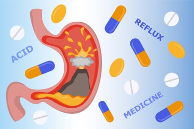 Illustration of Heartburn treatment. Stomach illustration and antacid pills falling on light blue background. Erupting volcano symbolizing acid indigestion