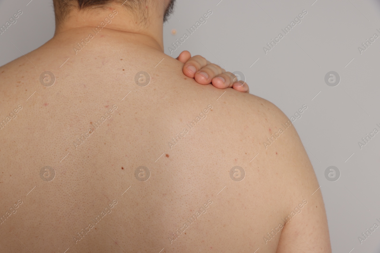 Photo of Closeup of man's body with birthmarks on light grey background, back view