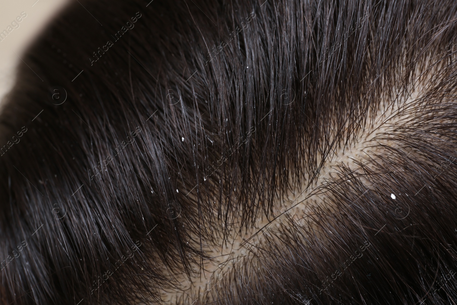 Photo of Woman with dandruff in her dark hair, closeup view