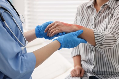 Photo of Doctor examining patient's burned hand in hospital, closeup