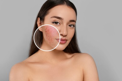Woman with acne on her face on grey background. Zoomed area showing problem skin