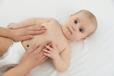 Image of Mother and her little child with red rash on bed, above view. Baby allergies