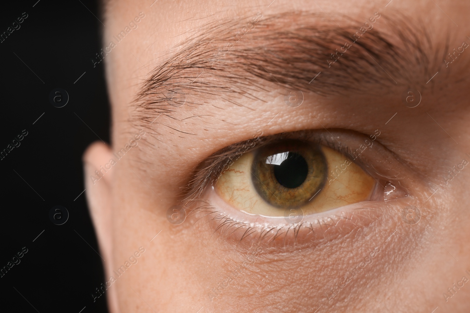 Photo of Man with yellow eyes on black background, closeup. Liver problems symptom