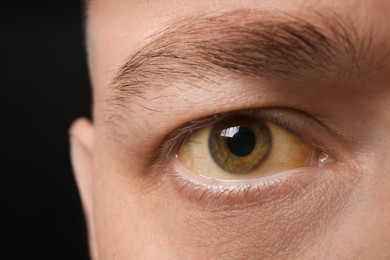 Photo of Man with yellow eyes on black background, closeup. Liver problems symptom