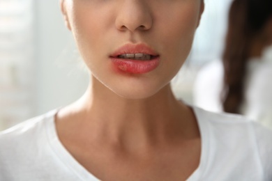 Photo of Woman with herpes on lip against blurred background, closeup