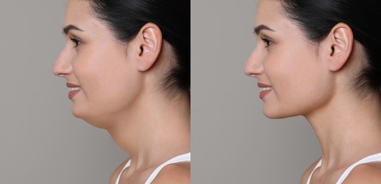 Image of Double chin problem. Collage with photos of young woman before and after plastic surgery procedure on light grey background, banner design