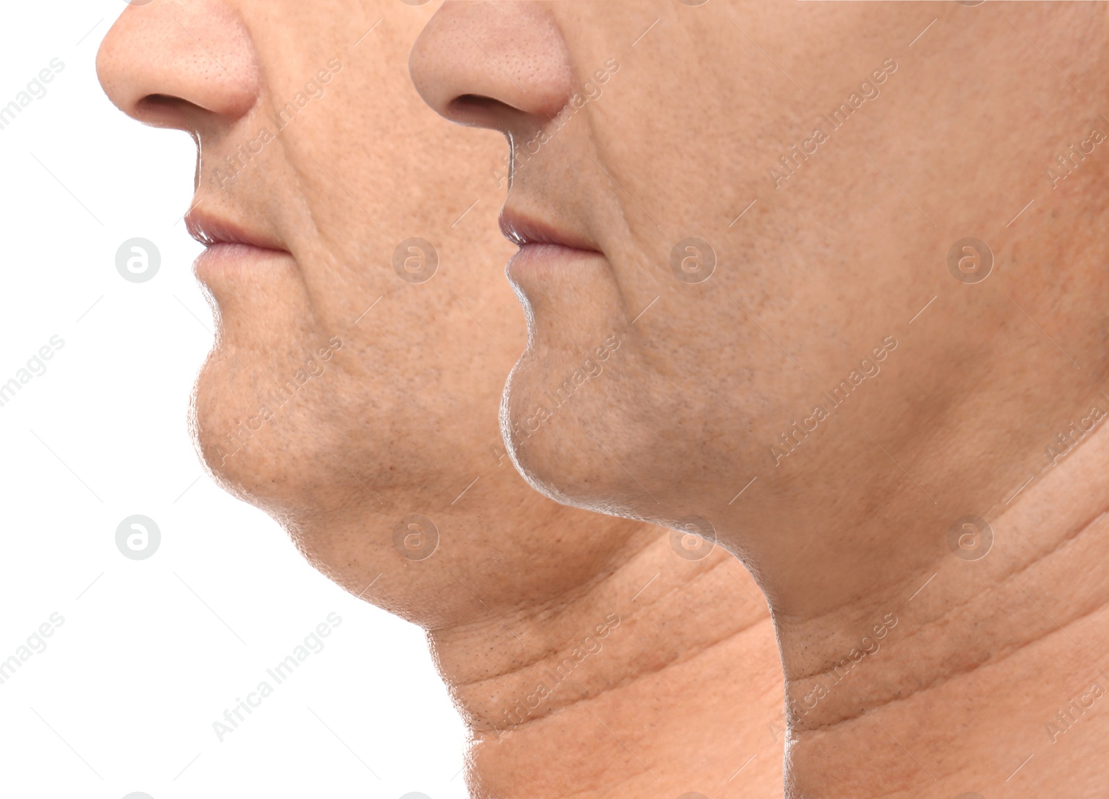 Image of Mature man before and after plastic surgery operation on white background, closeup. Double chin problem