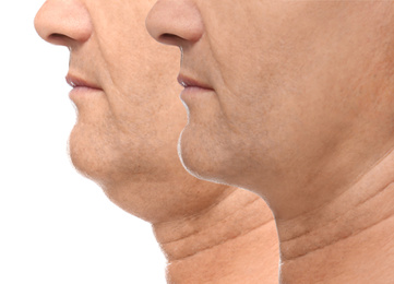 Mature man before and after plastic surgery operation on white background, closeup. Double chin problem