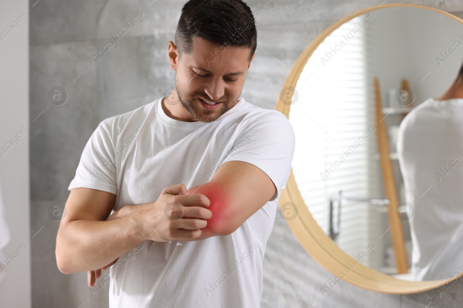 Photo of Man suffering from allergy scratching his arm indoors