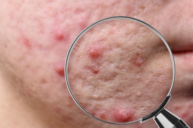 Dermatology. Woman with skin problem, closeup. View through magnifying glass on acne