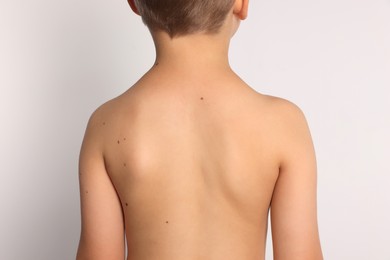 Photo of Closeup of boy's body with birthmarks on light grey background, back view