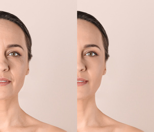 Mature woman before and after cosmetic procedure on beige background 