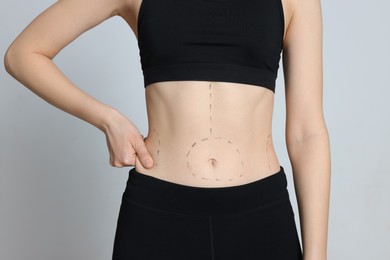 Photo of Slim woman with marks on body against light background, closeup. Weight loss surgery