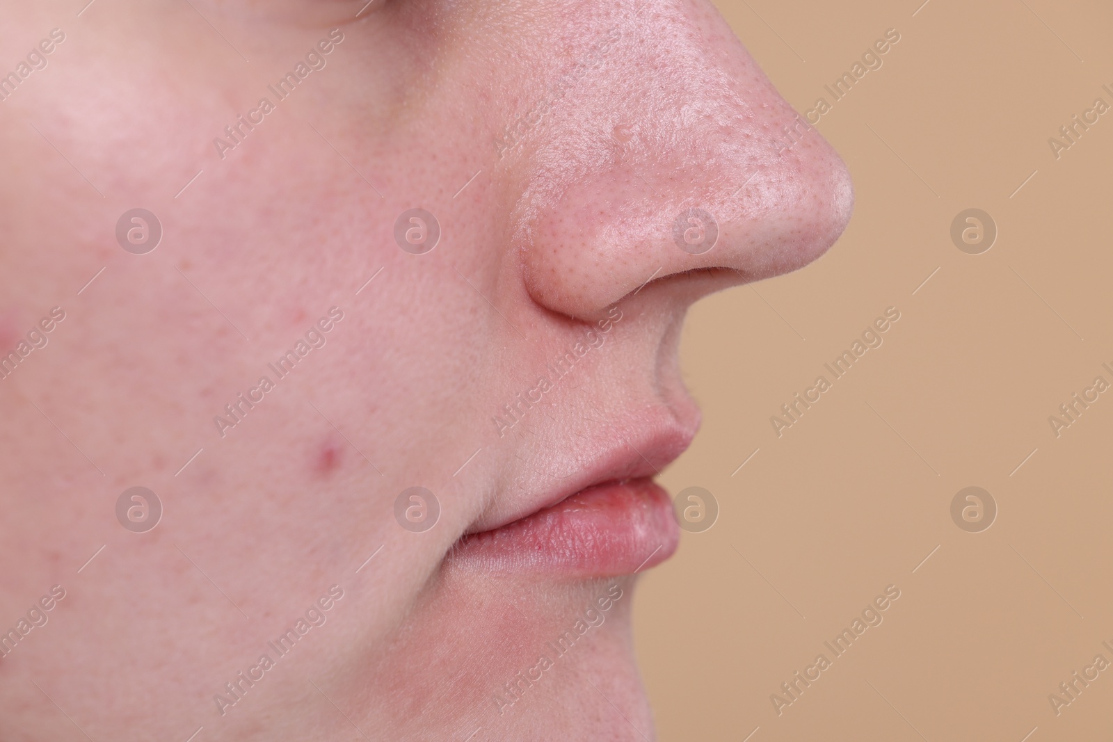 Photo of Closeup view of woman with blackheads on her nose against beige background, space for text