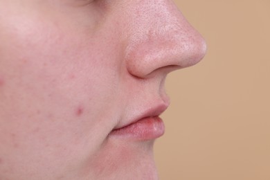 Closeup view of woman with blackheads on her nose against beige background, space for text