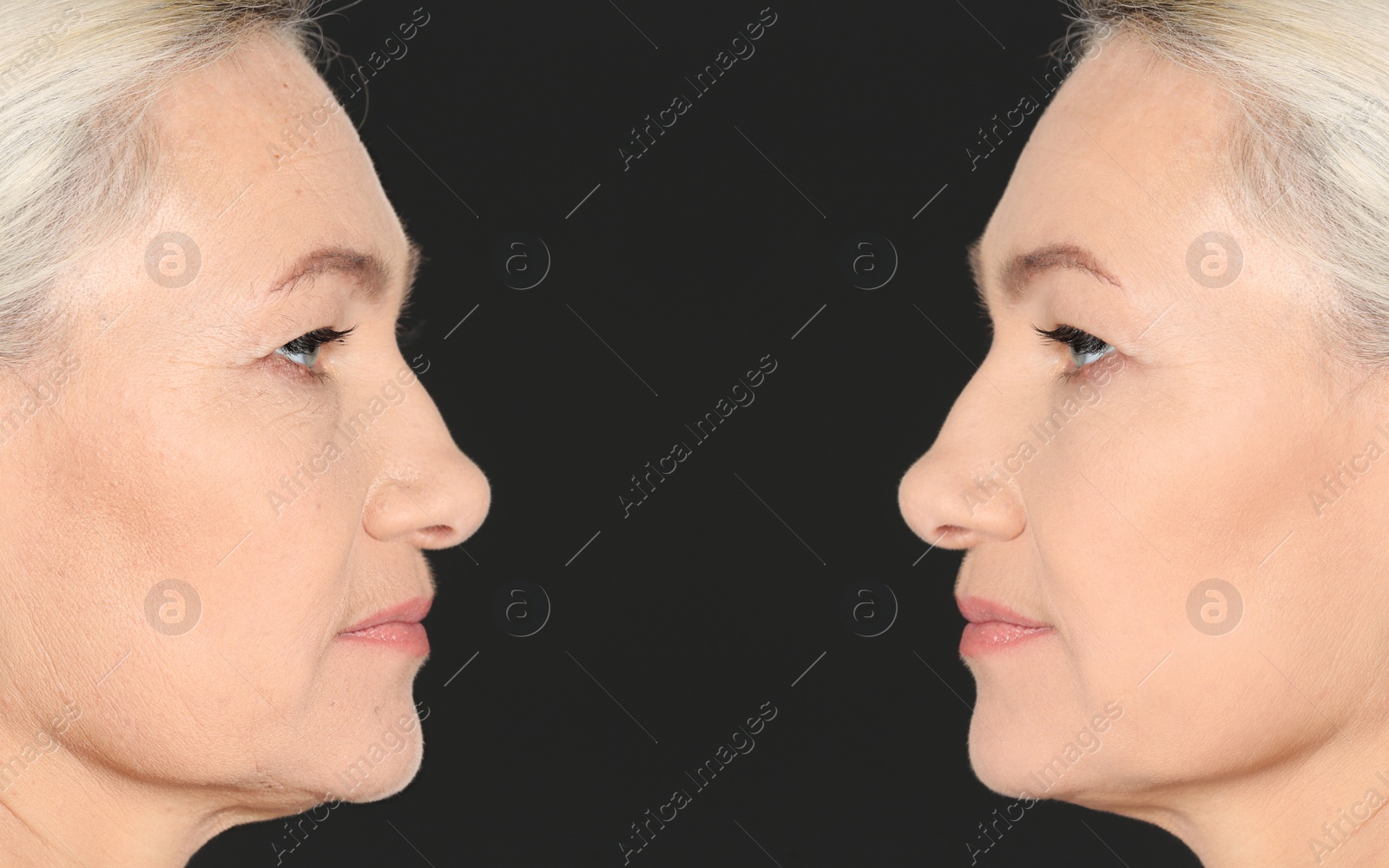 Image of Beautiful mature woman before and after cosmetic procedure on black background, collage. Plastic surgery