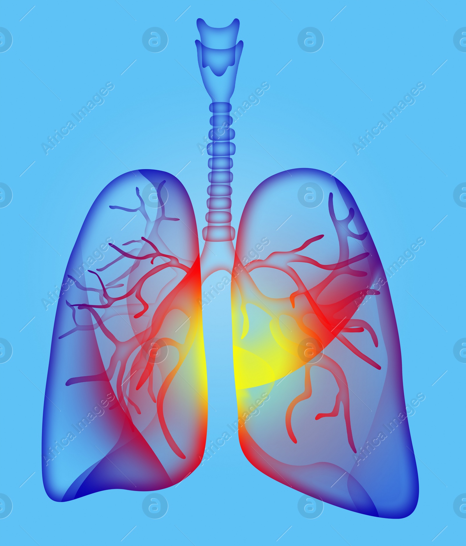 Illustration of  human lungs affected with disease on light blue background