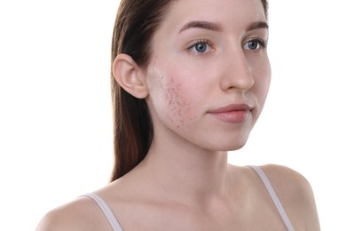 Photo of Young woman with acne problem on white background