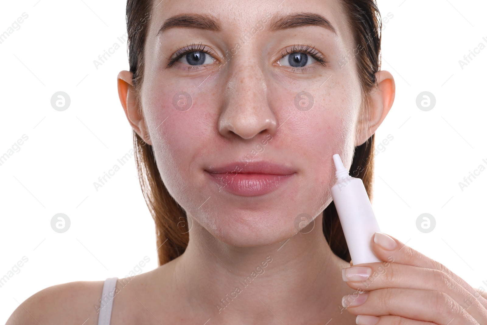 Photo of Young woman with acne problem applying cosmetic product onto her skin on white background, closeup