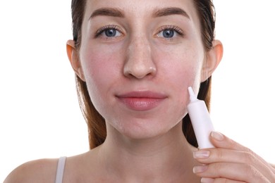 Photo of Young woman with acne problem applying cosmetic product onto her skin on white background, closeup