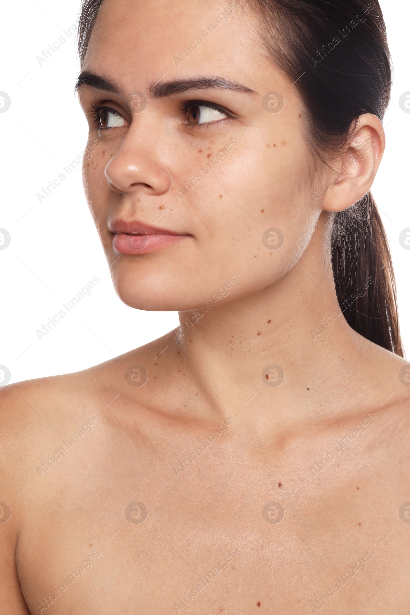Photo of Beautiful woman with birthmarks on white background
